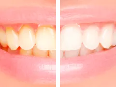 Branqueamento Dentário