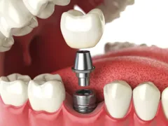 Implantes dentários