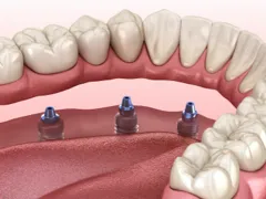 Próteses Dentárias Fixas