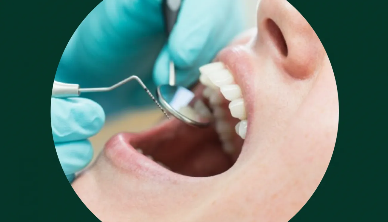 Tratamento de cáries
